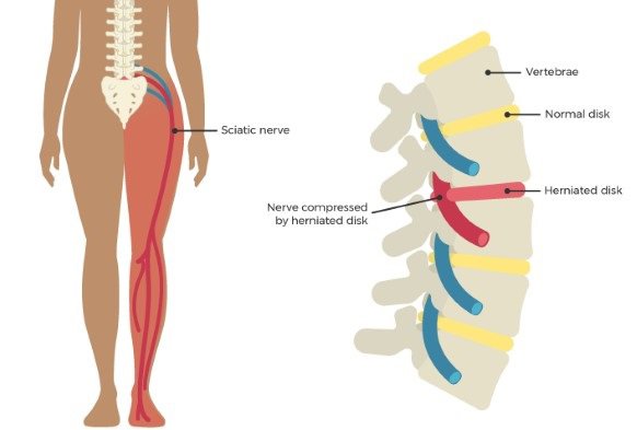 Sciatic pain explained